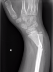 Galeazzi fracture dislocation